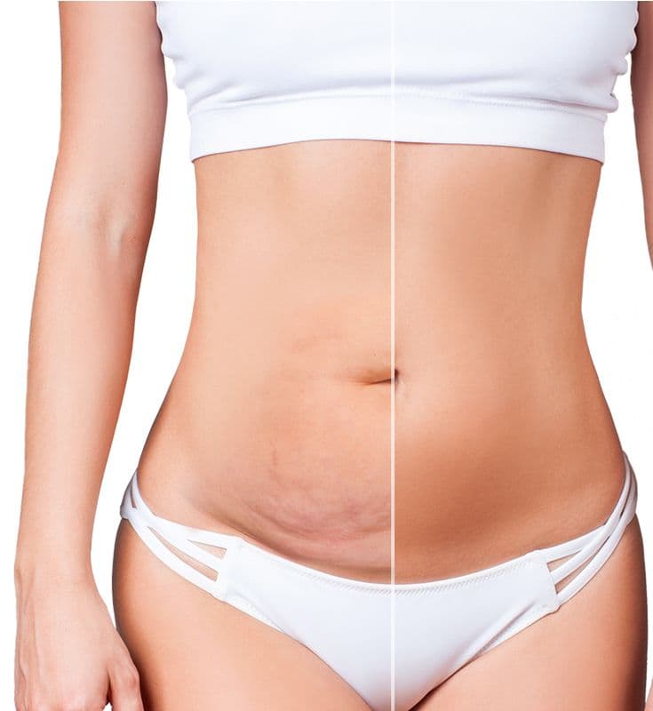 Mommy Makeover: todo lo que debes saber antes de tu cirugía