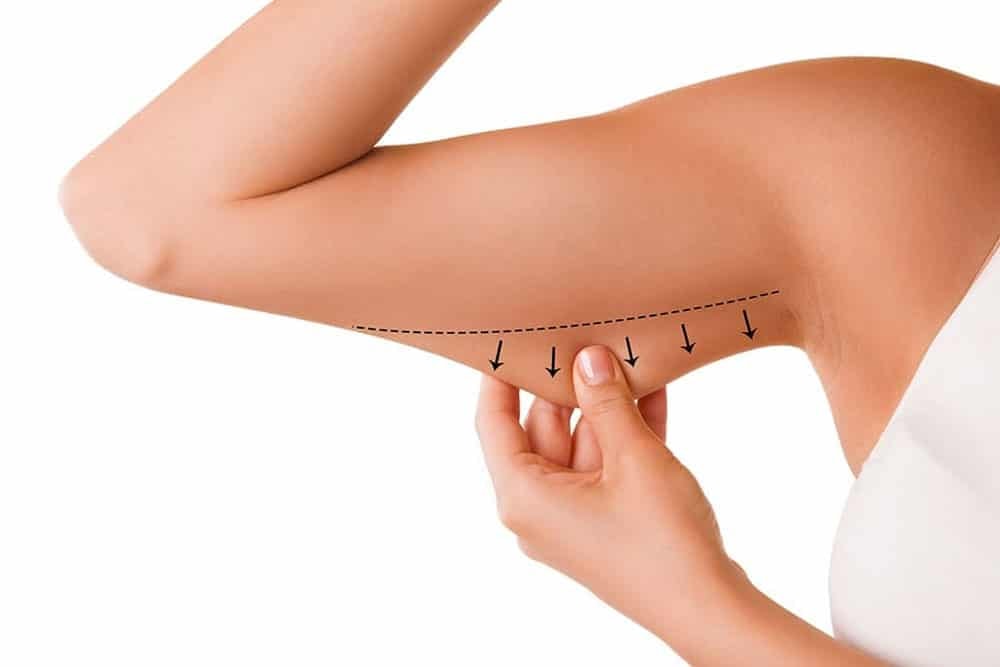 Braquioplastia