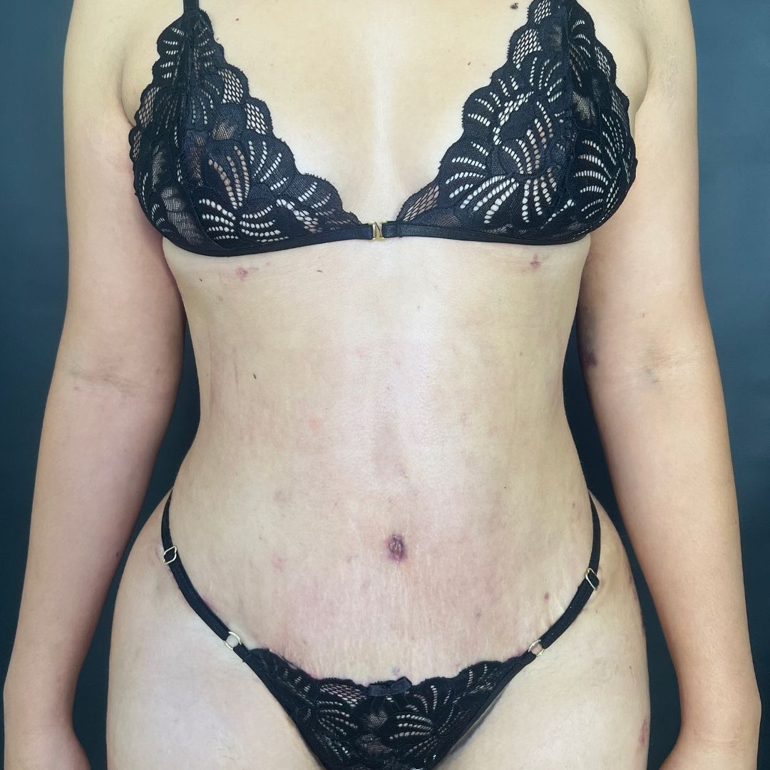 Resultado de abdominoplastia a los 20 días — Dra. Greys Pérez M., Barranquilla